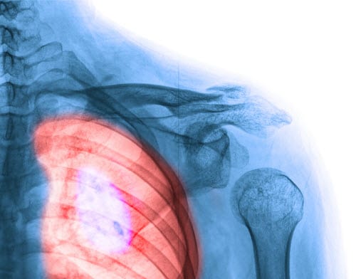 Cancer Mistakes & Medical Malpractice