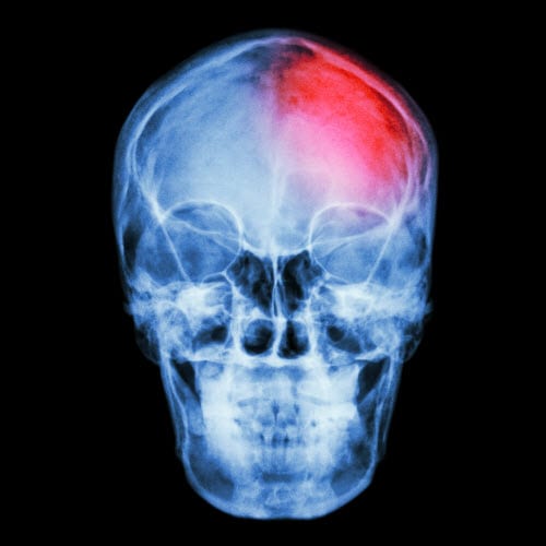 Head or Brain Injury at Work