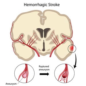 Delayed hemorrhagic stroke diagnosis