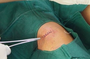 knee surgery complications