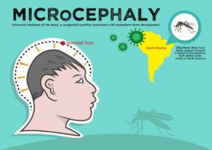 microcephaly and zika