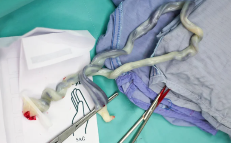 What Are the Causes of Birth Asphyxia 2
